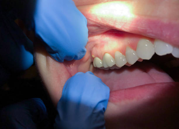 Best Emergency Denture Repair in Redlands, CA